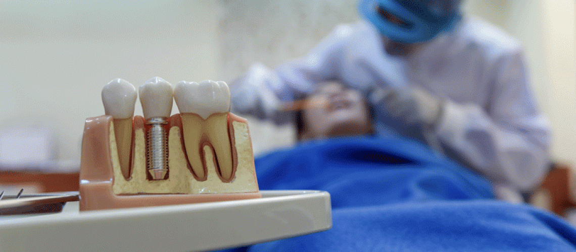 Capped dental implant model on desk in dentists’ office with copy space. Focusing shoot on dental implant model.